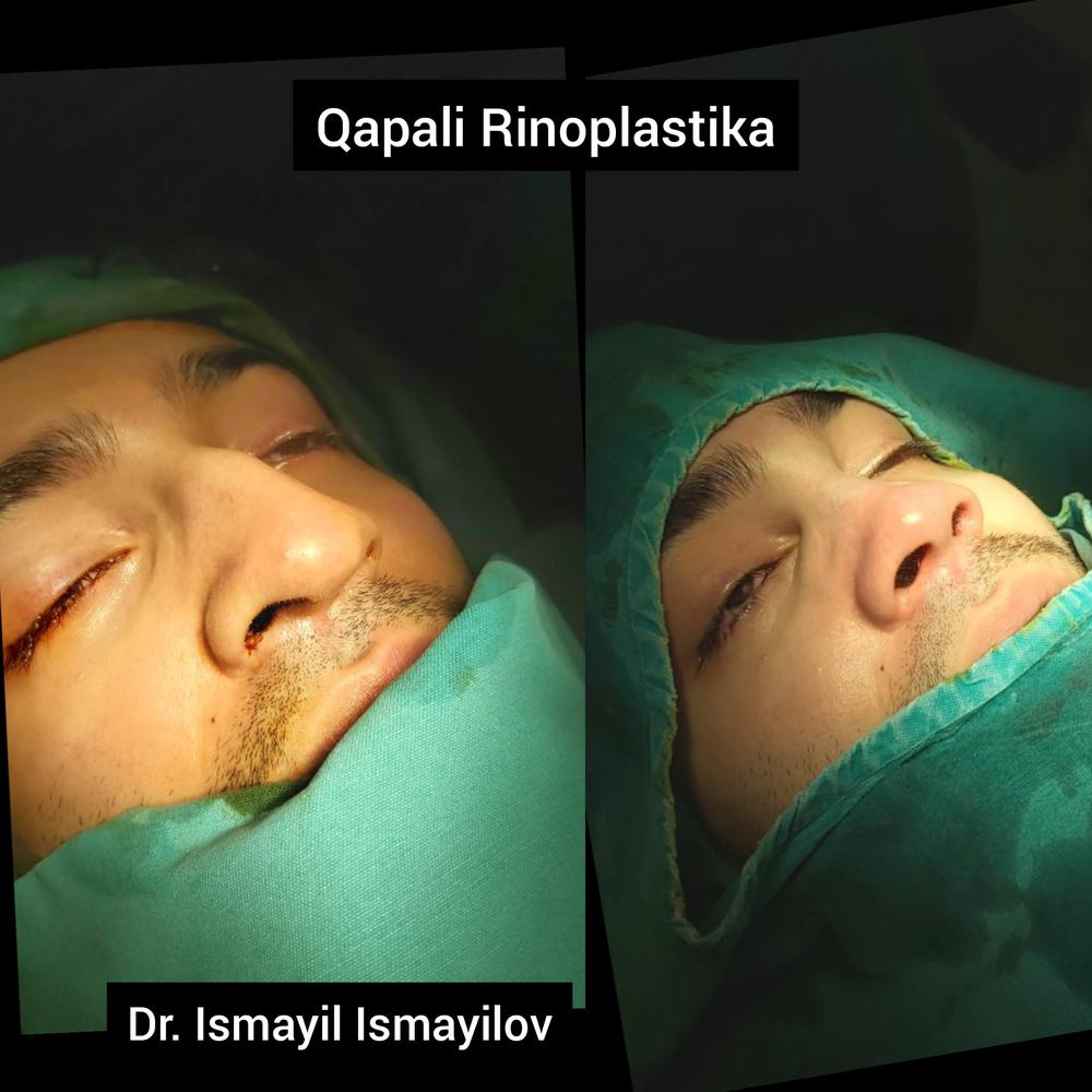 Закрытая ринопластика - фото сразу после операции