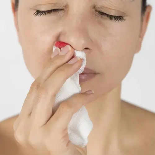 Носовые кровотечения — состояние, которое может быть весьма опасным для жизни пациента.