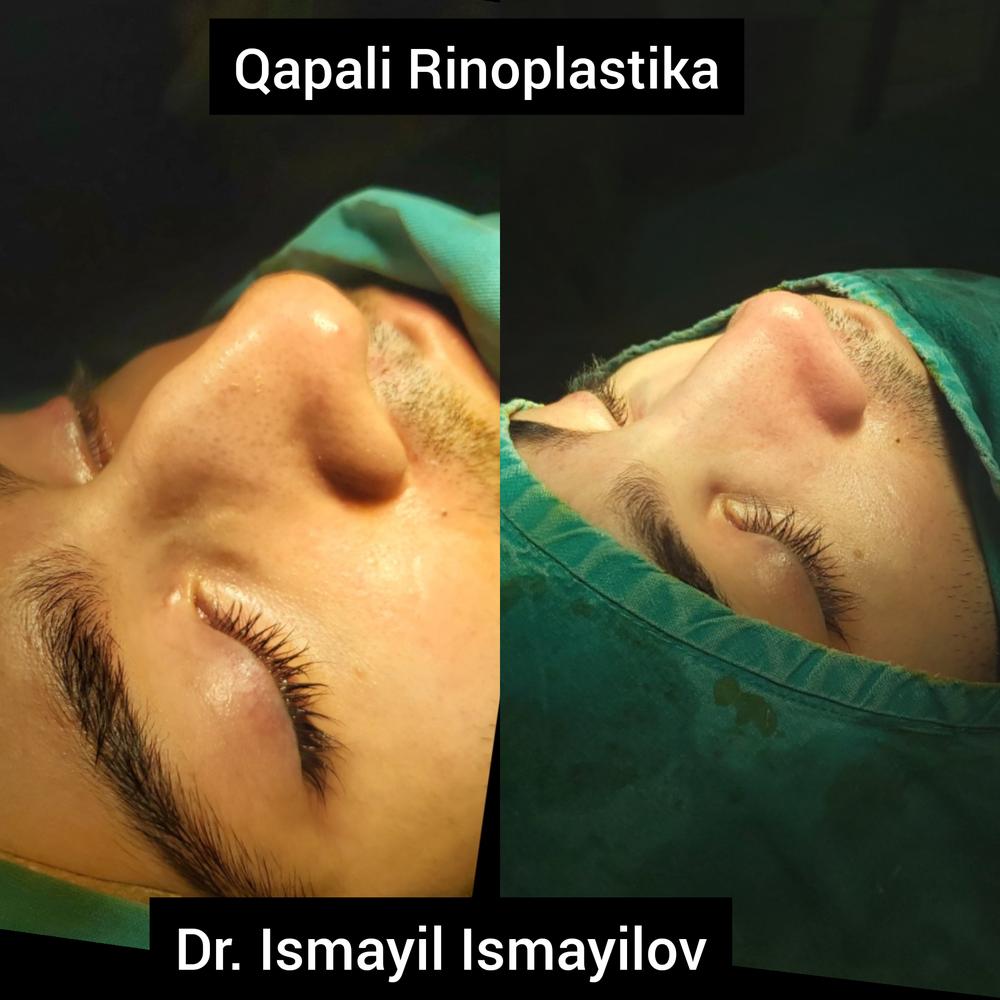 Closed Rhinoplasty - pictures immediately after the operation