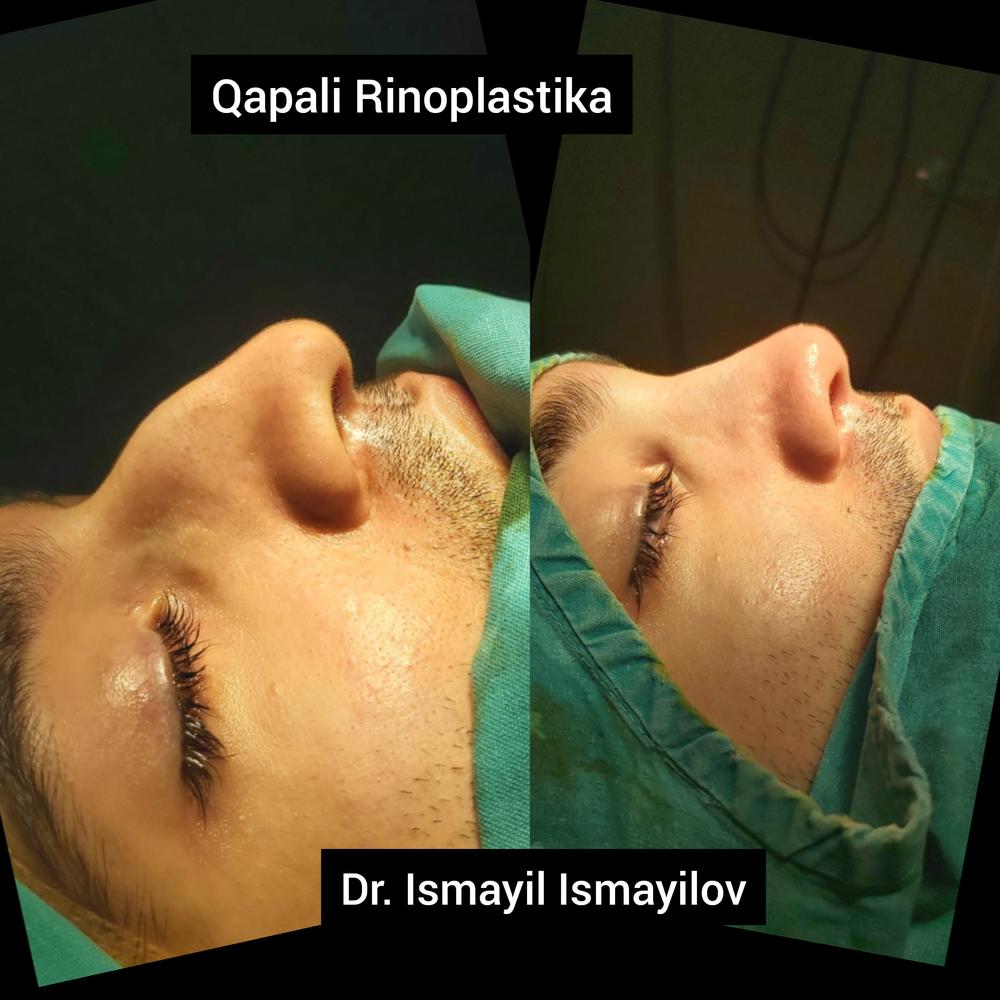 Closed Rhinoplasty - pictures immediately after the operation