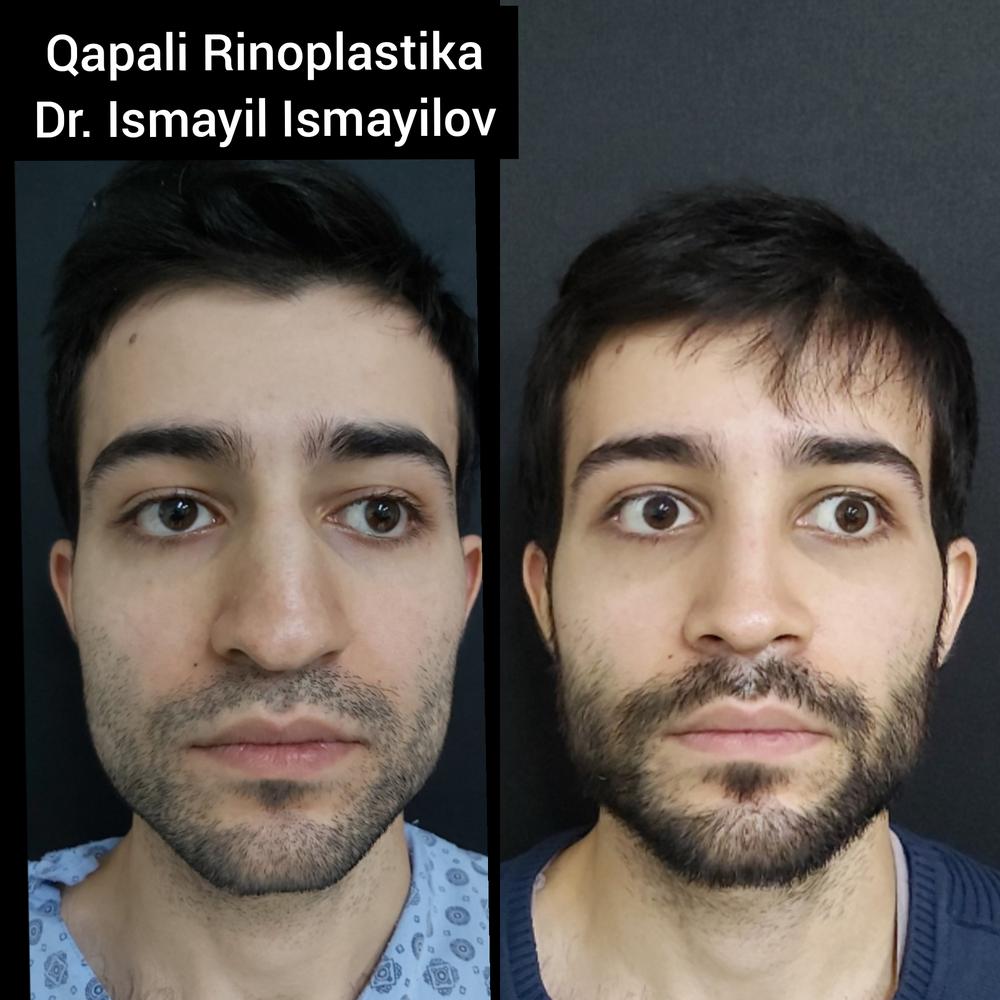 Rhinoplasty photo - 6 month after surgery.