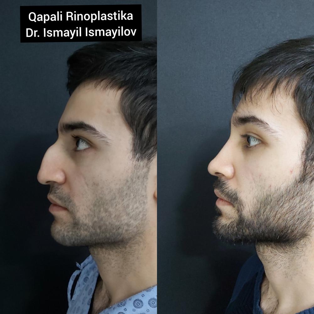 Rhinoplasty photo - 6 month after surgery.