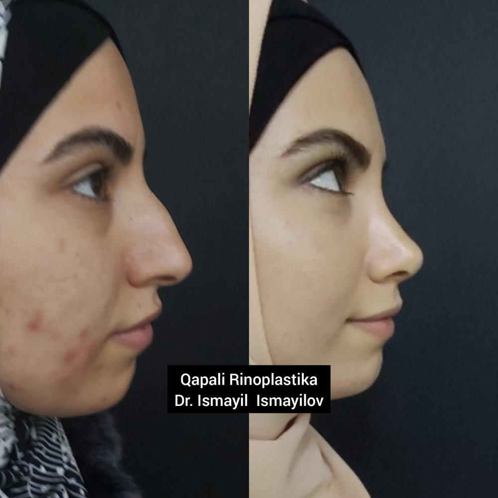 Rhinoplasty photo - 3 month after surgery. Thick skinned nose.