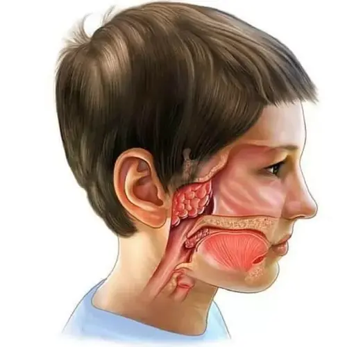 Adenoids - a pathological condition of the tonsils of the nasopharynx