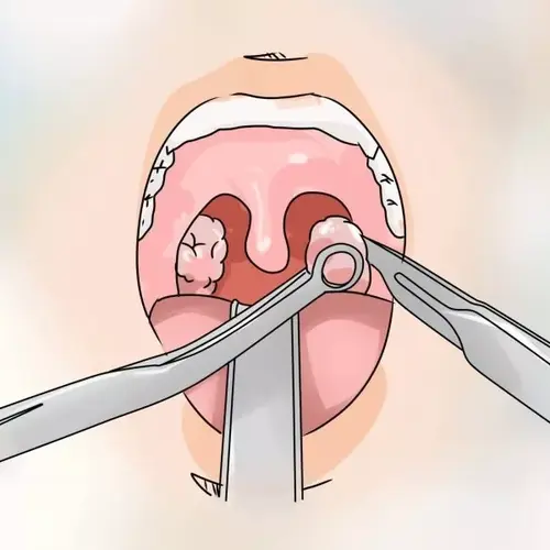 Classical tonsillectomy - procedure for the operation